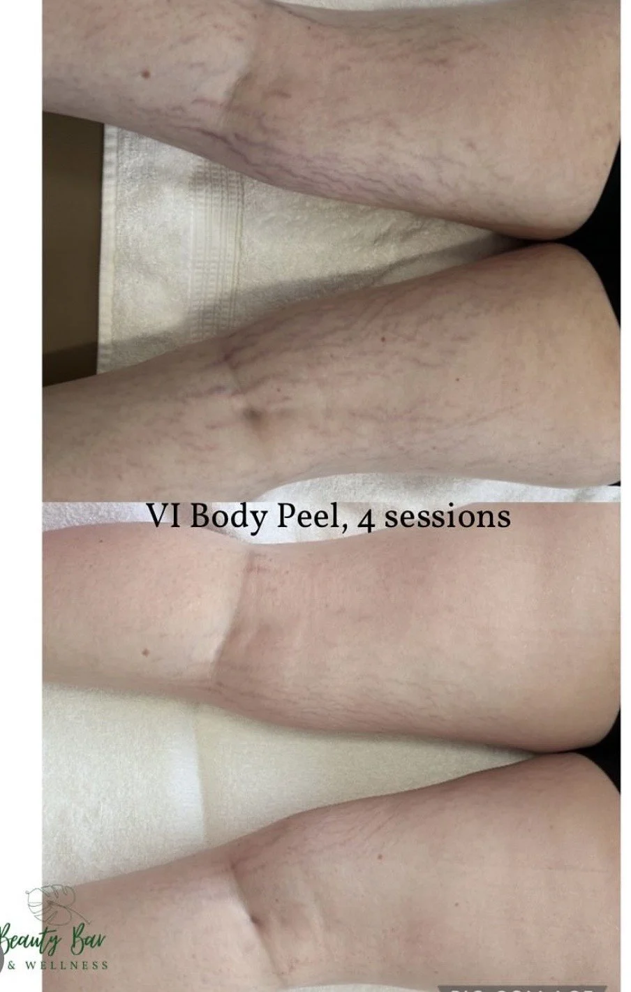 Before and After 4 VI Body Peel Treatments