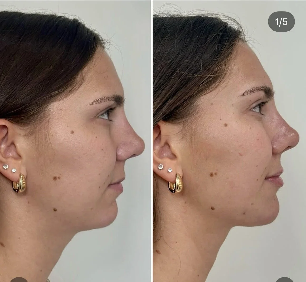 Before and After Lip and Chin Filler