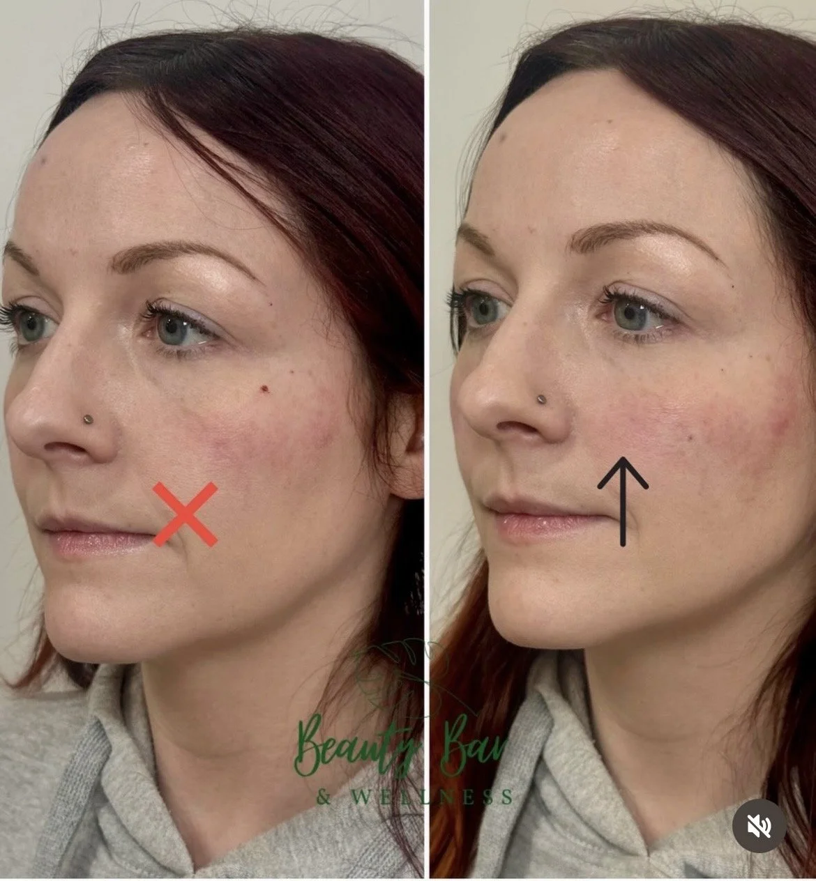 Before and After Cheek Filler