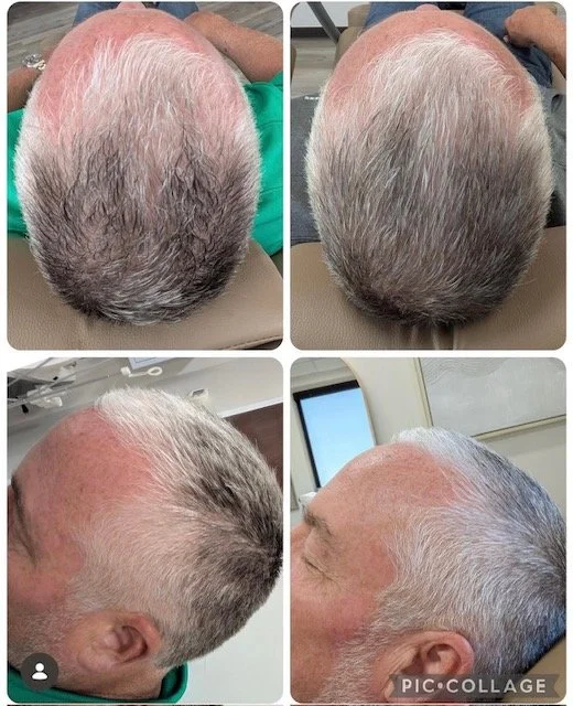 Before and 4 Weeks Post 1 Hair Restoration Treatment