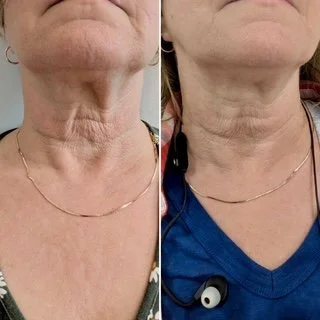 Before and After 1 Hyperdilute Radiesse Neck Treatment 