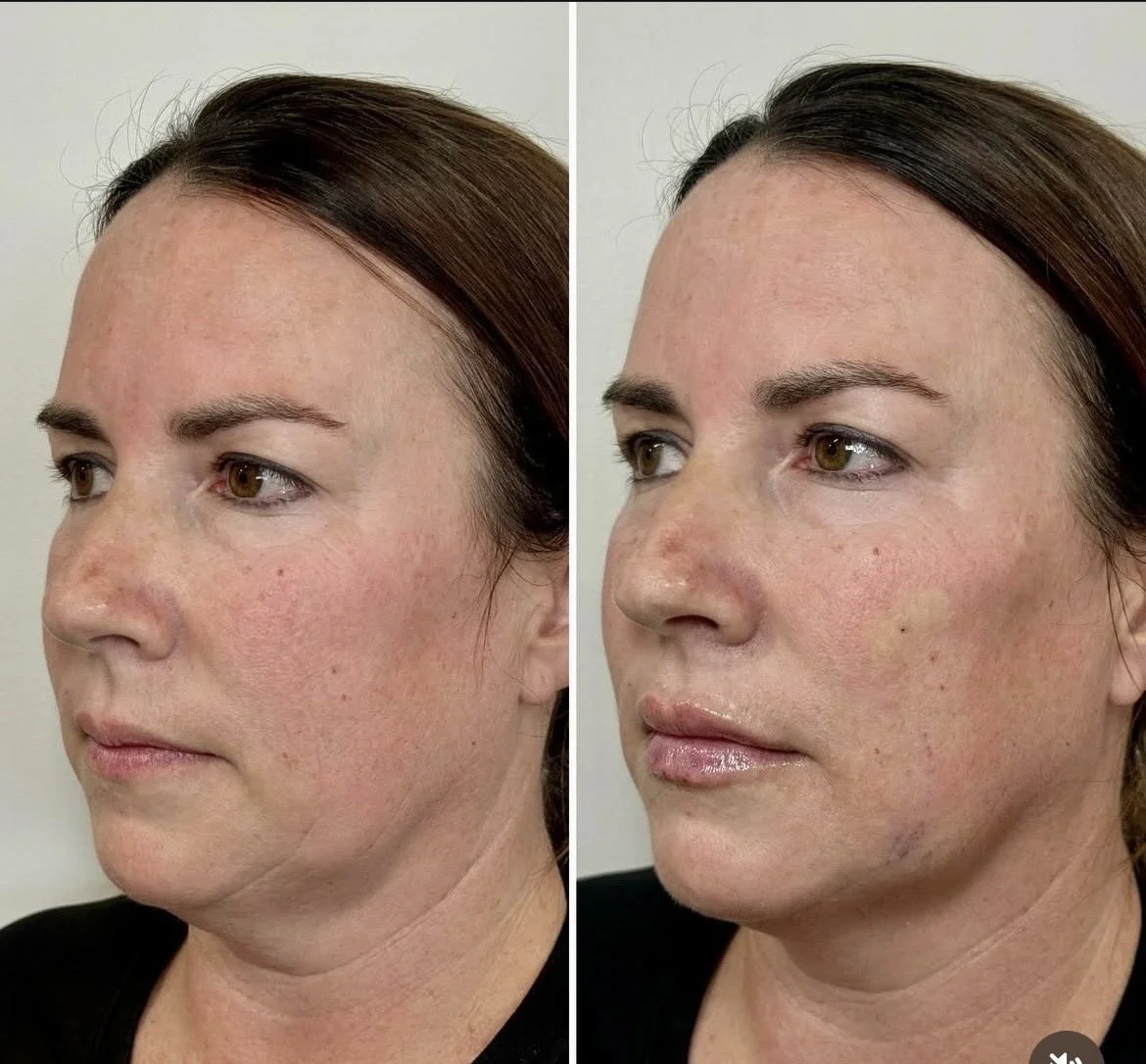 Before and After Full Face Rejuvenation with Filler