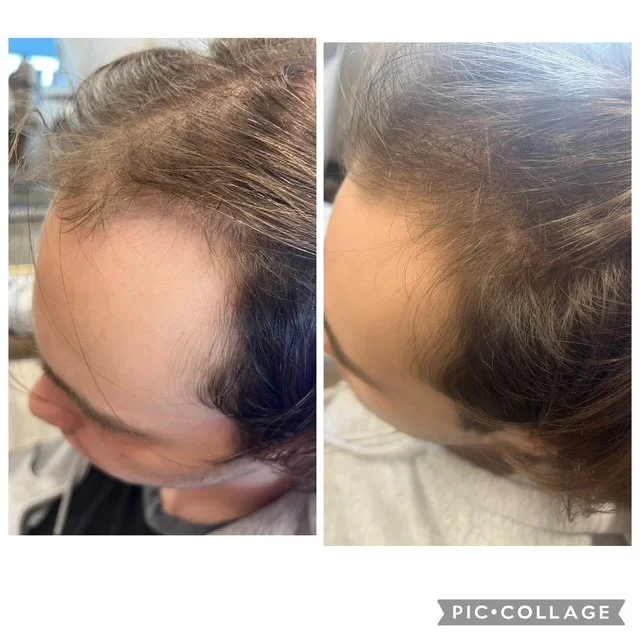 Before and After 1 Hair Restoration Treatment (6 weeks apart)