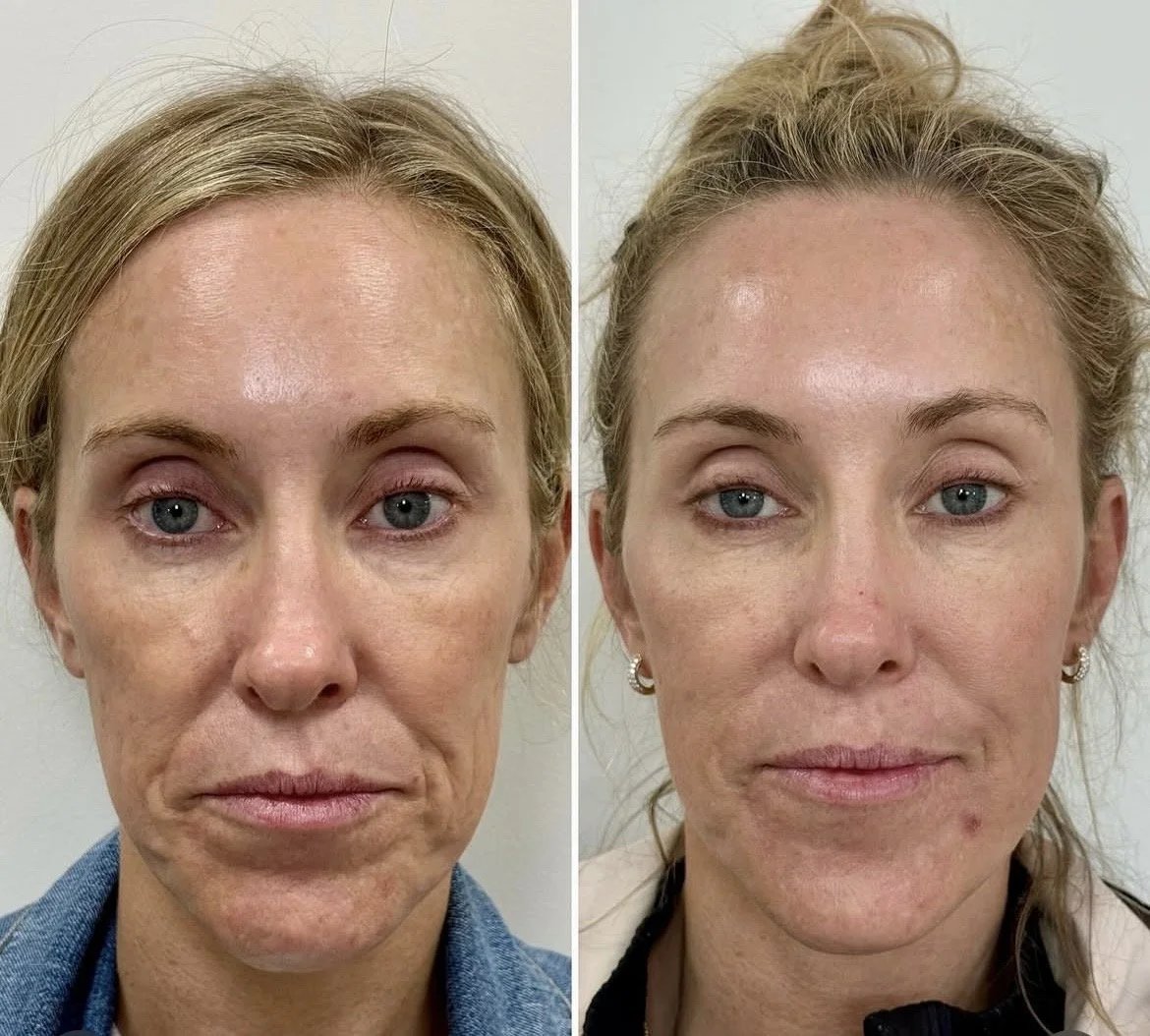 Before and After Full Face Rejuvenation with RHA Filler