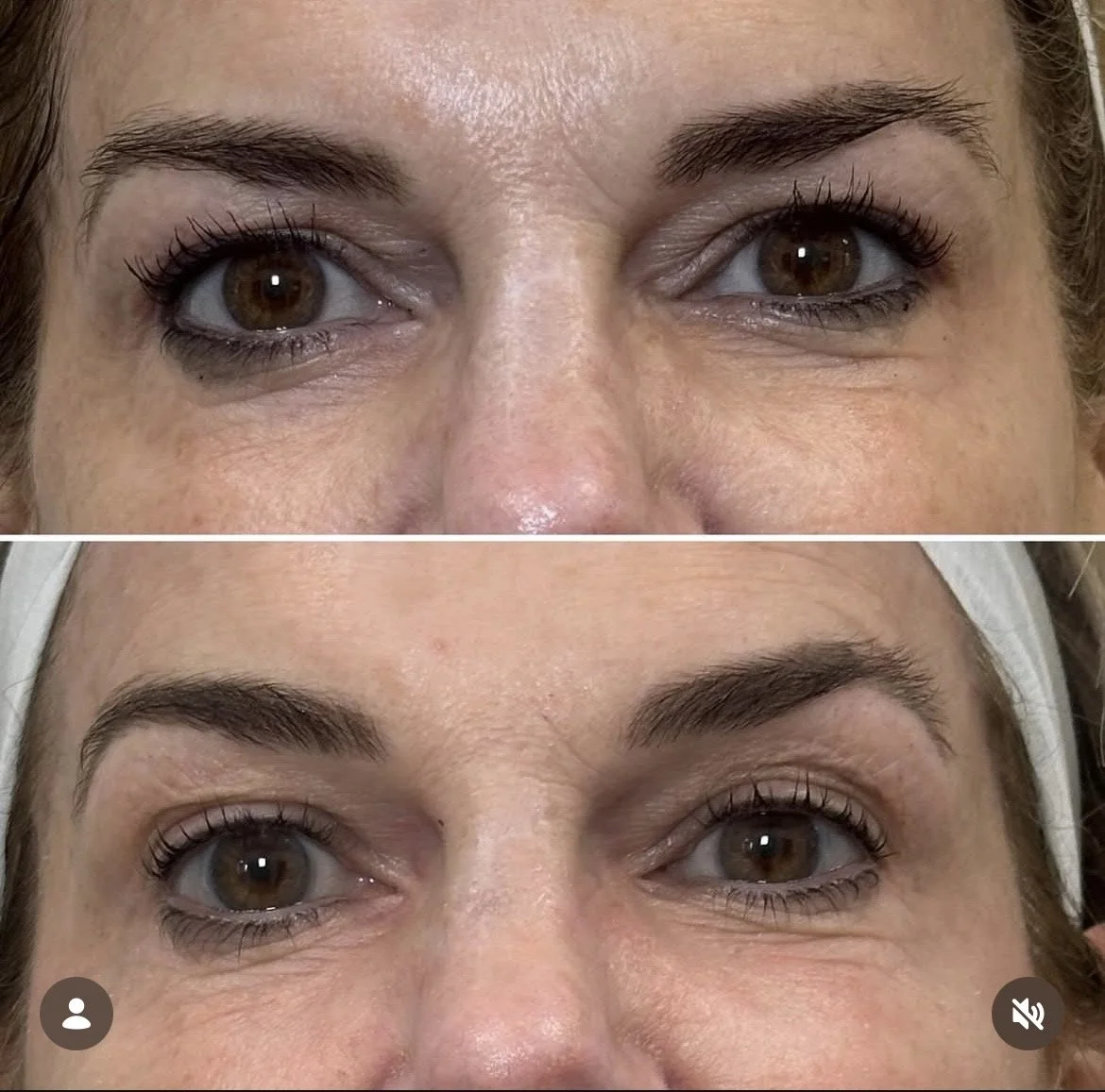 Before and After UltraClear Laser Coring Eyebrow Lift