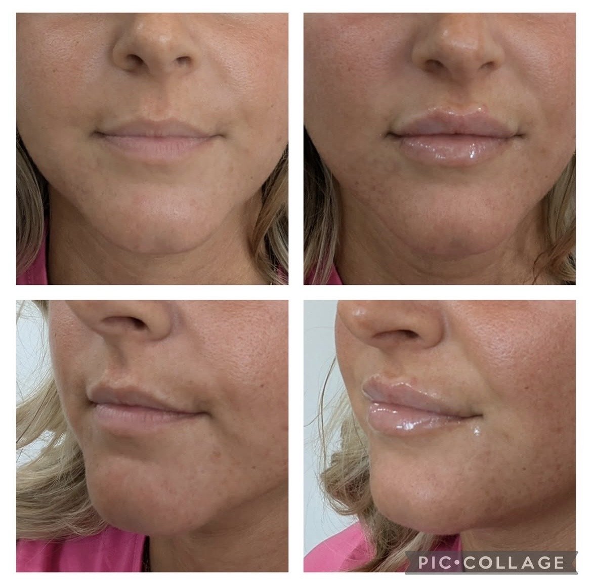 Before and After Lip Filler