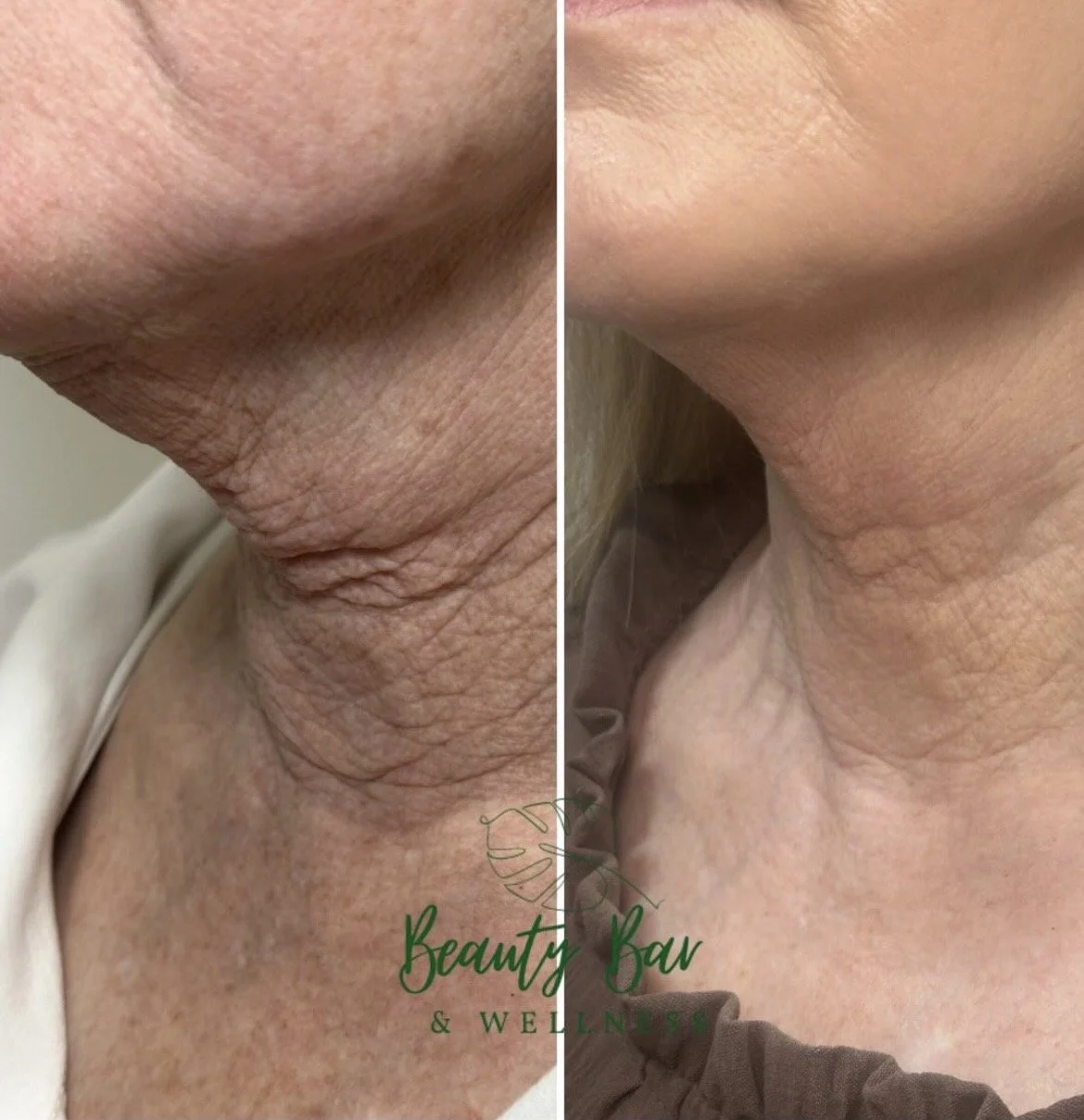 Before and After 1 UltraClear Laser Coring Neck Treatment