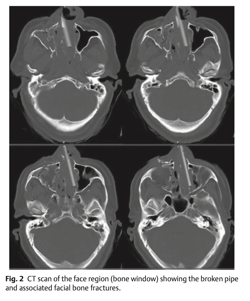 Penetrating craniofacial trauma- motorcycle vs PVC truck