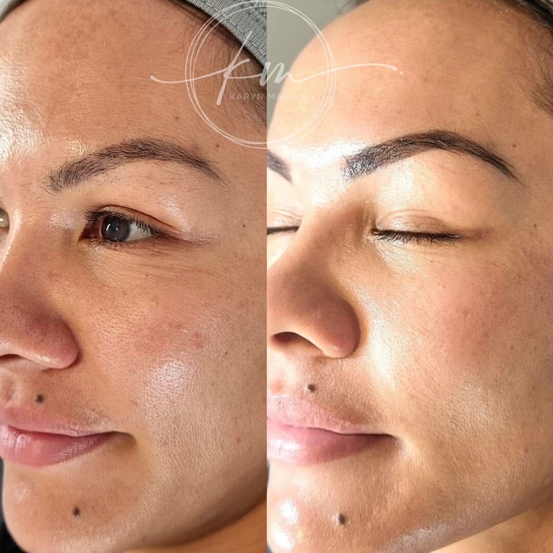 No filters necessary!😍 Just gorgeous glowing and even radiant skin with the new and improved BB Glow for @ailsa_castles and @justinemartin4816 today, it doesnt get any better! Suitable for all skin types and conditions with specialised ampoules and 