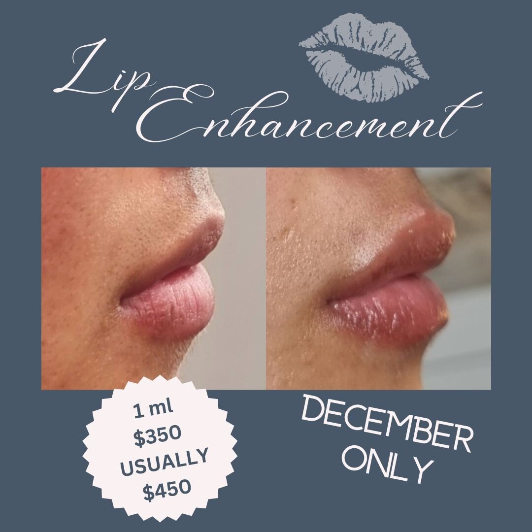 Subtle lip enhancement and rejuvenation using the Hyaluron pen. Medical grade Hyaluronic acid filler administered using the Hyaluron pen using pressure to deposit the filler in to the superficial layers of the skin, meaning no needles!!
Walk in and w