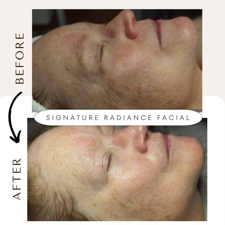 ✨Signature Radiance Facial✨

Look at that shine👌🏼

➡️Book yours now! Get that skin shiny and ready for the summer parties

☀️don&rsquo;t forget sunscreen!☀️

#facial #radiance #beforeandafterfacial #skincare #circadiaskincare #selfcare