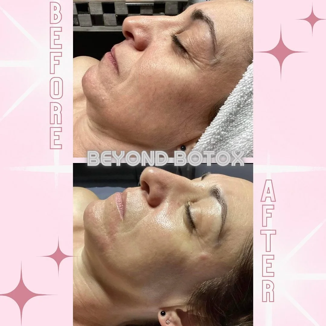 botox.jpeg