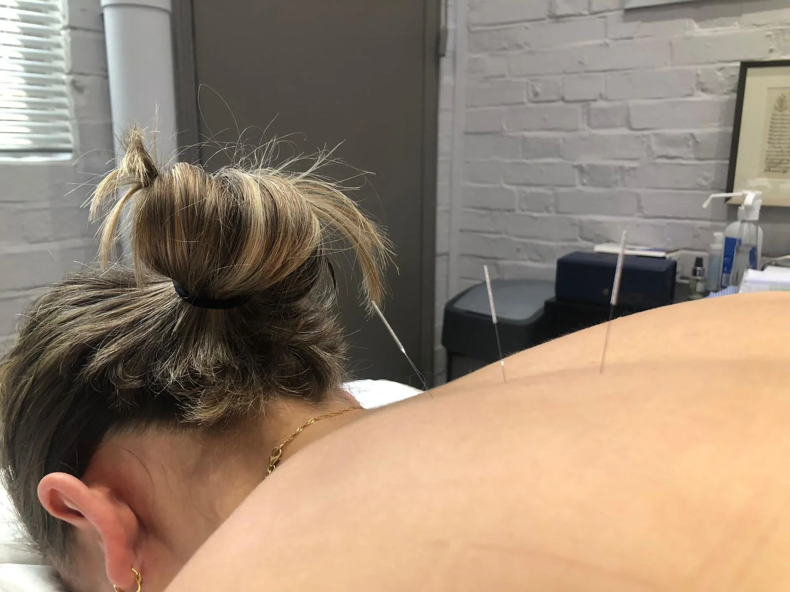 Acupuncture and Stress: Can needles score a bullseye for stress management?