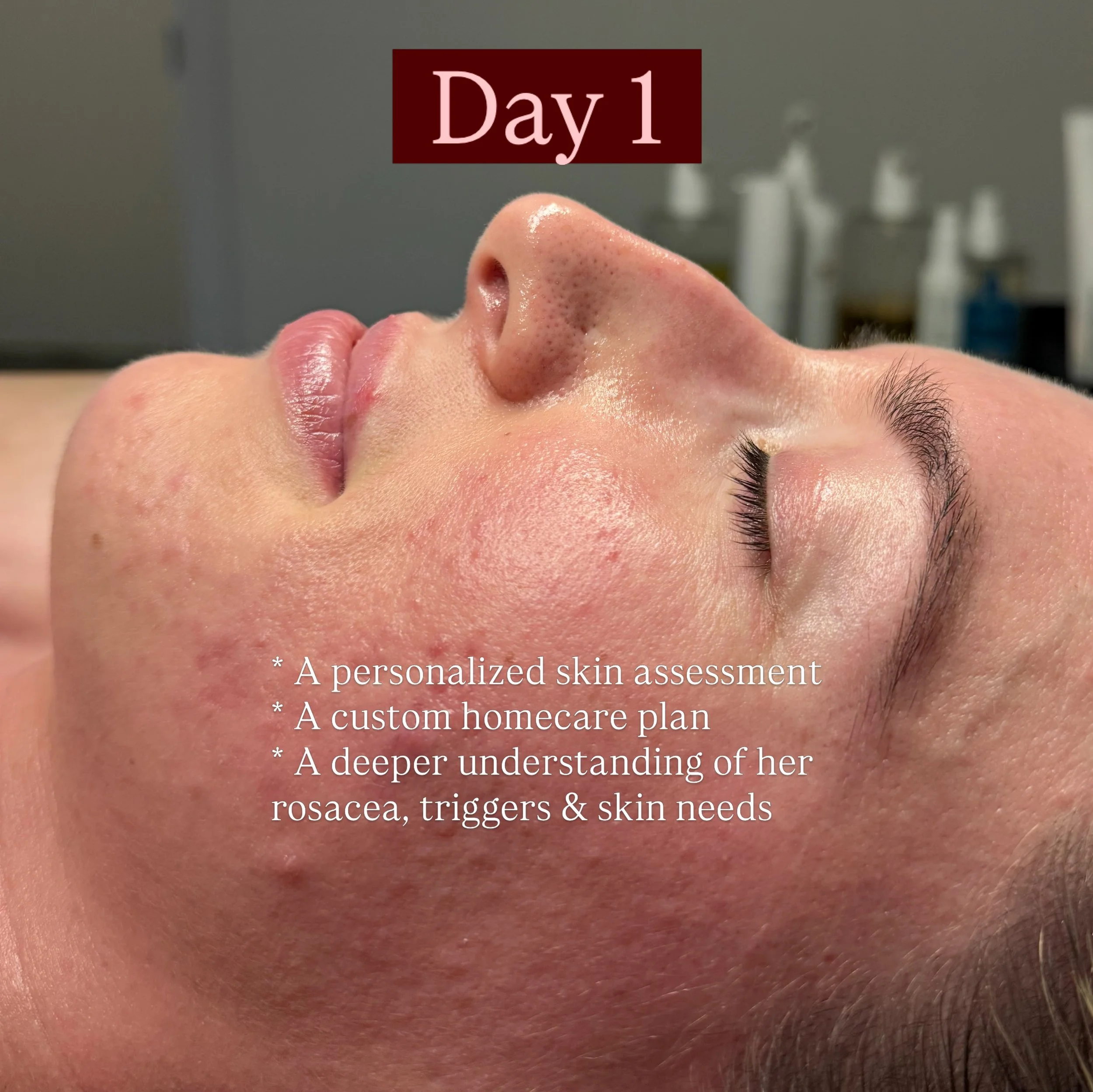 Day one ➝ 2-week check-in ✨

A reminder that healthy skin is a journey &mdash; and real results take consistency, the right plan, and time. 

We&rsquo;ve started to see some beautiful progress already, and I can&rsquo;t wait to see how her skin conti