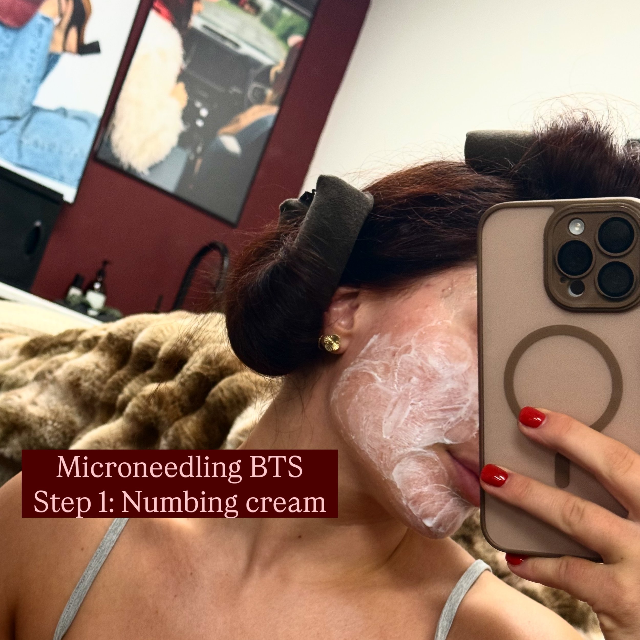 The microneedling process 🩸✨