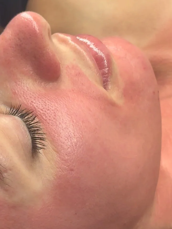 6 days of healing &amp; check ins with my beautiful client ❤️

Consider this ✨your sign ✨ to finally try microneedling 😍

And the best part? The results are just getting started. Collagen production and skin renewal continue in the weeks following t