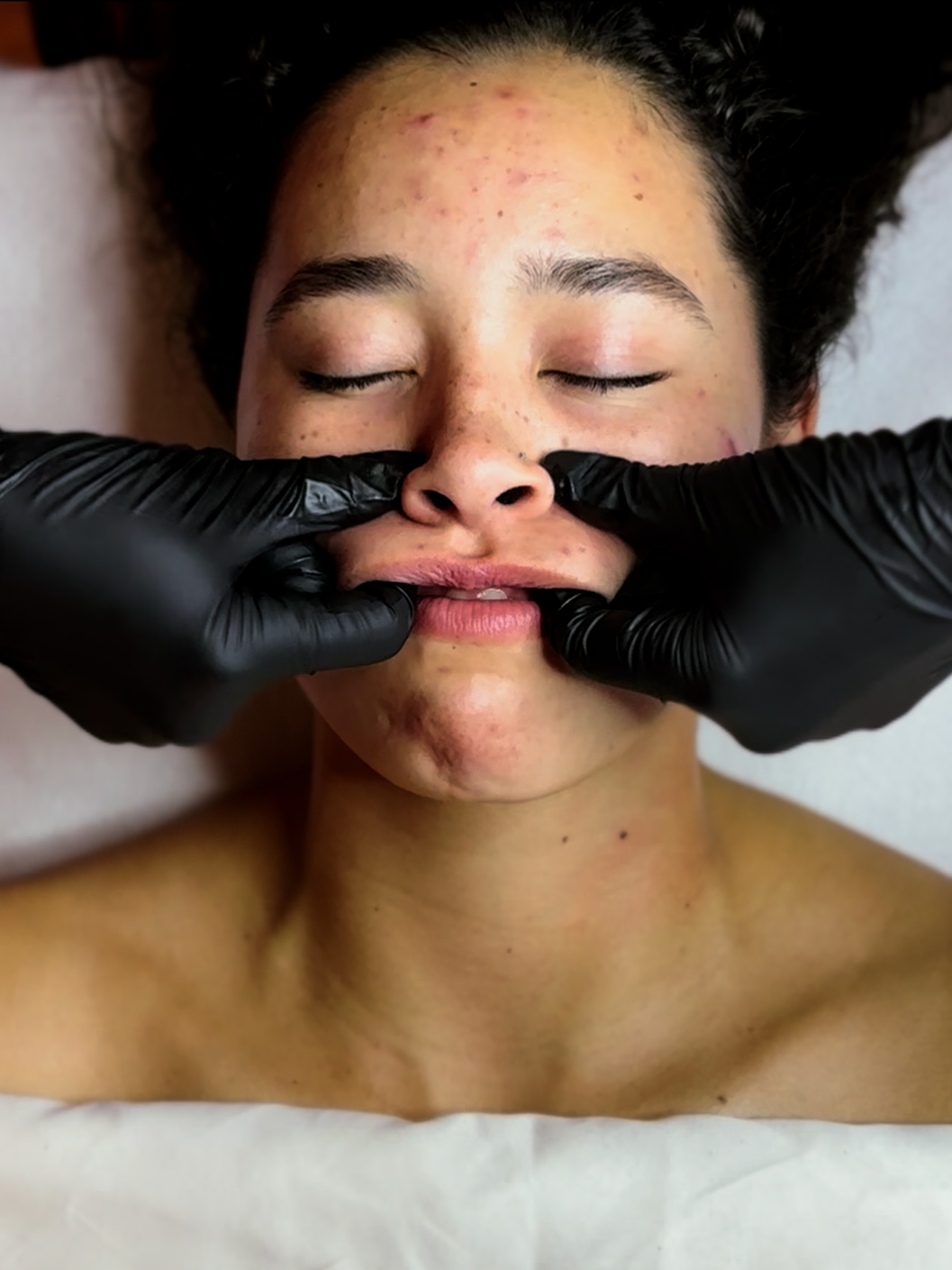 A person receiving a cosmetic treatment on their lips from a professional wearing black gloves, lying down with eyes closed.