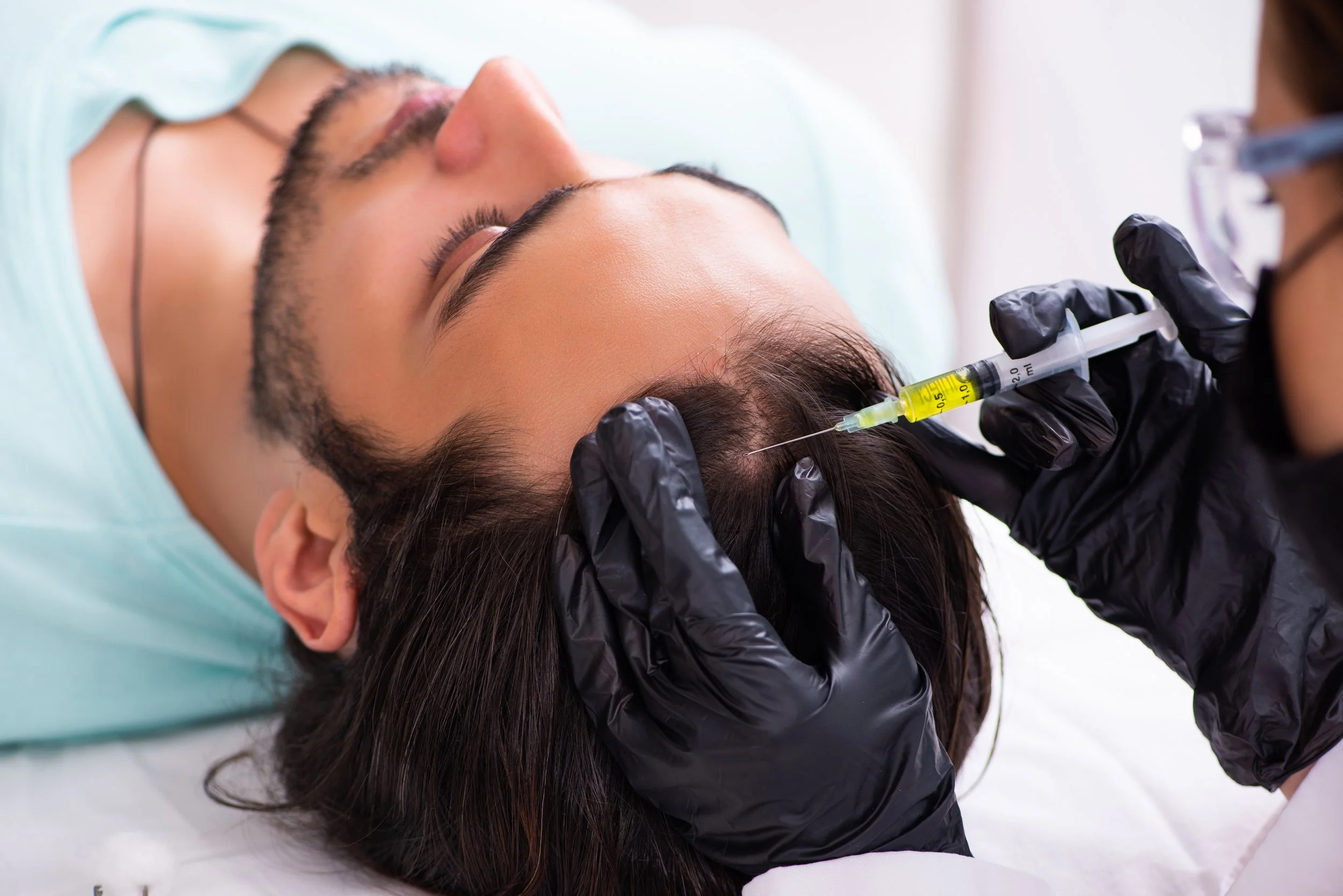 Male PRP Hair loss injection treatment in fairfax, mclean