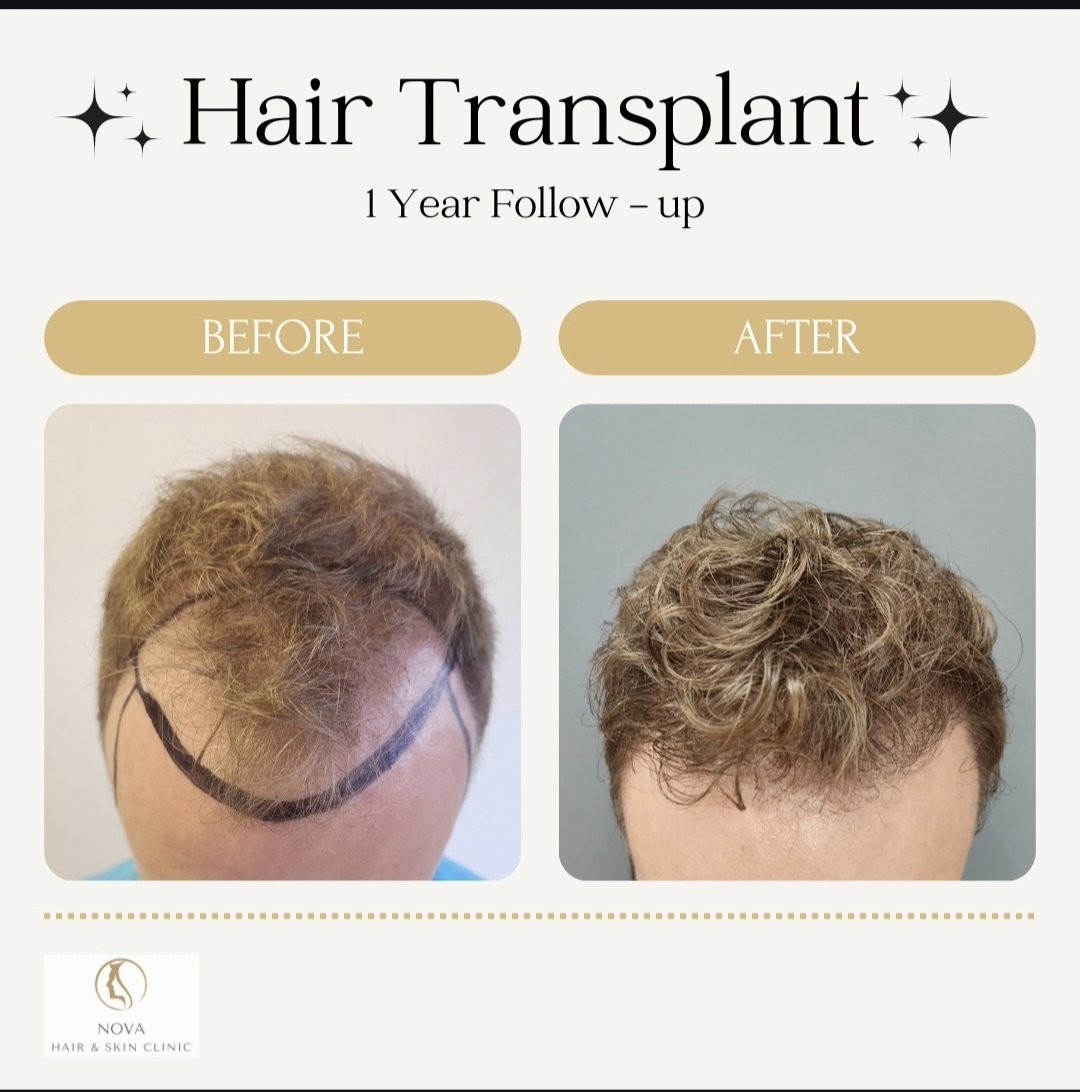 Hairline Transplant FUE