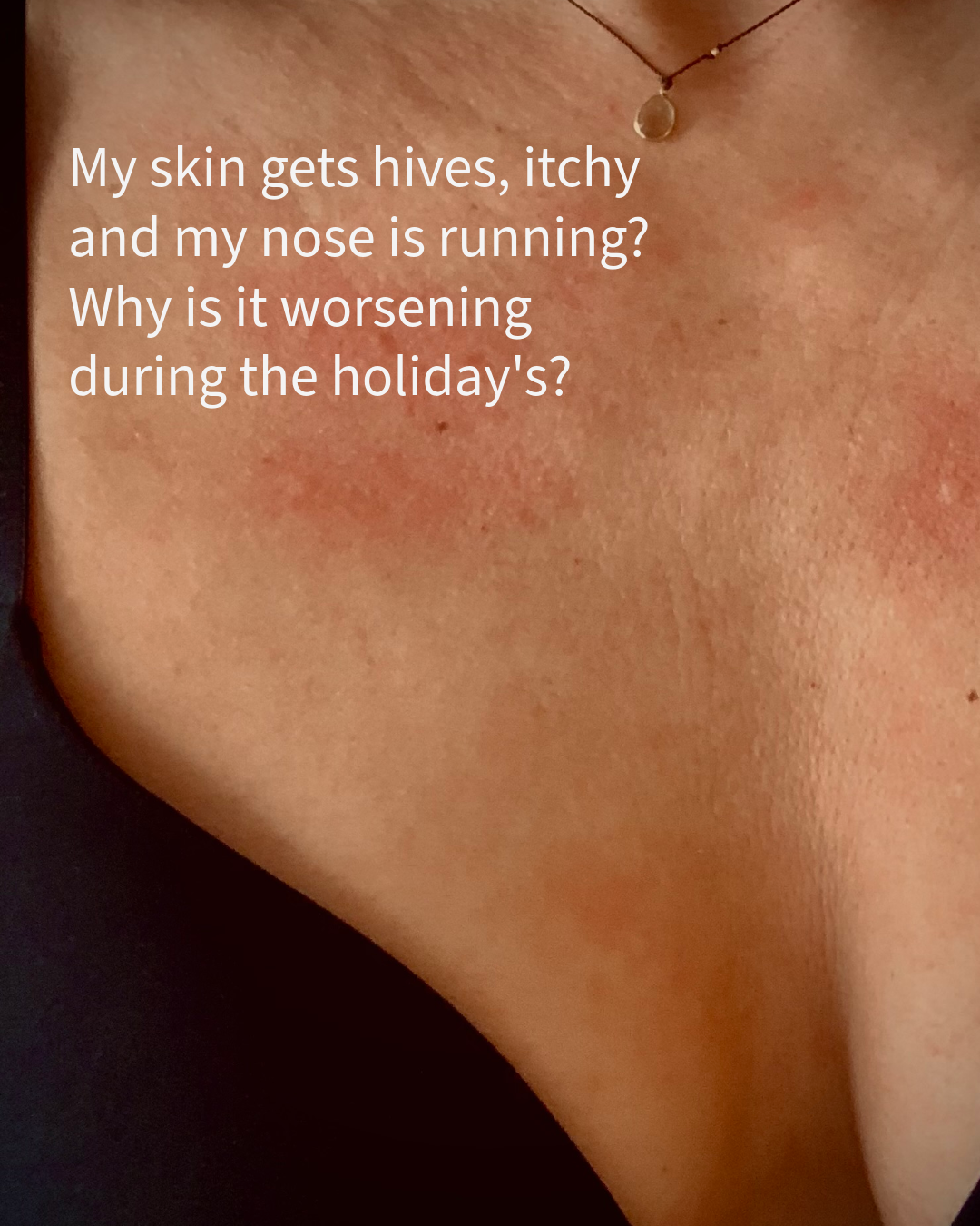 Histamine, Mast Cells &amp; Estrogen — Say What?  