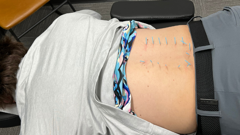 Acupuncture & Dry Needling