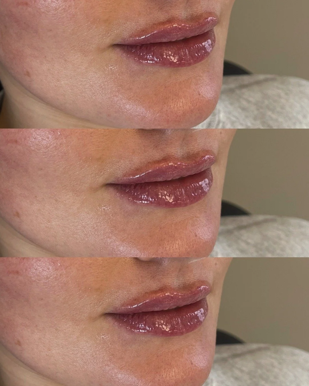This client came in feeling like her lips no longer enhanced her natural proportions. 👄

Previous filler had migrated, creating lumps, bumps, and asymmetries that were changing her overall look. Instead of adding more, we focused on refining the fou
