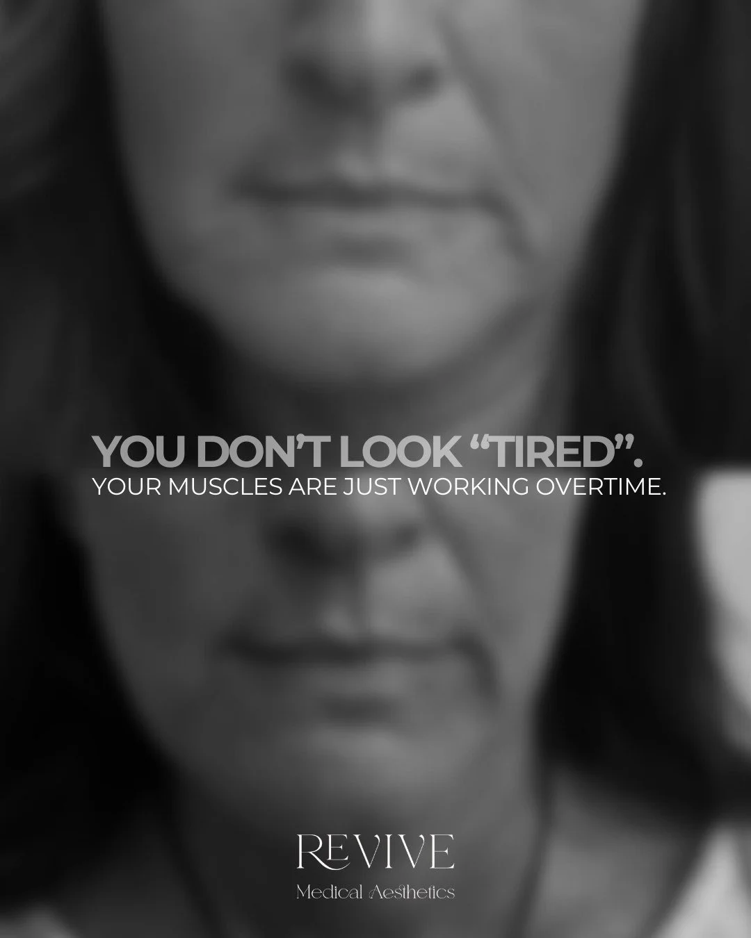 Most people think they need to &ldquo;fix the wrinkle.&rdquo; But wrinkles are rarely the real issue.

They&rsquo;re the result of repeated muscle movement over time.

For this client, we treated:

-Frontalis (forehead)- to soften horizontal lines
-G