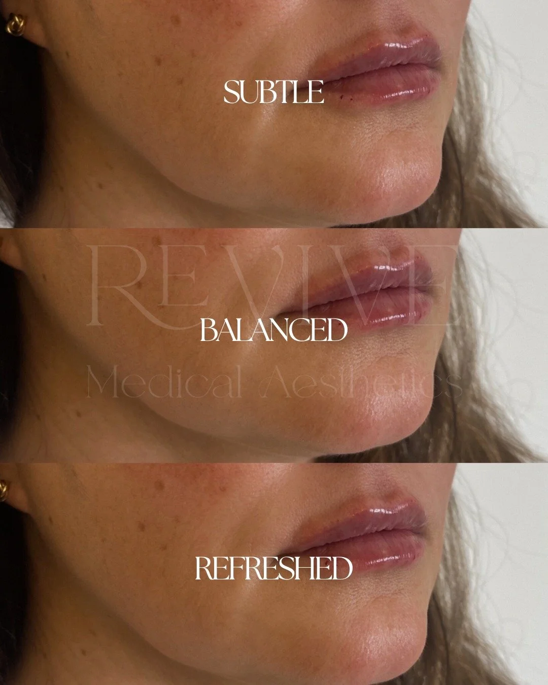 What a slow, subtle enhancement can look like 👉🏼

These gorgeous lips were built gradually over time, with the main focus being on balance.

👄 She wanted more hydration, crisper borders, and a natural balance between her upper and lower lip.

To s