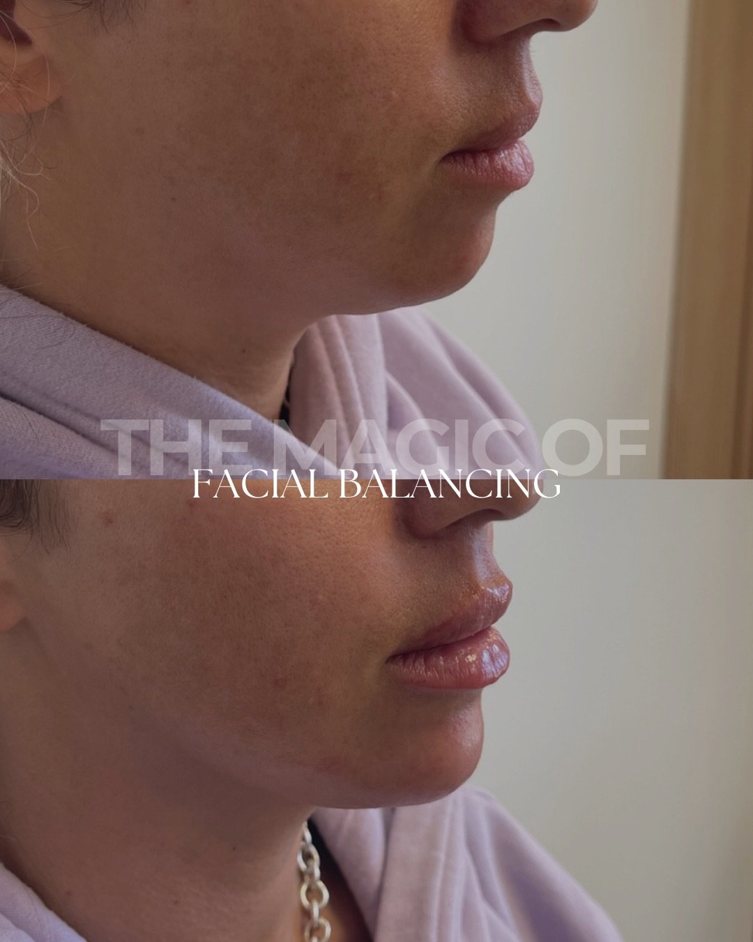 Facial balancing is one of my favourite treatments to do because it&rsquo;s never just about one area.

In this case, we treated the lips and chin, but the result goes far beyond that.

👉🏼 By adding a bit of structure and projection through the chi