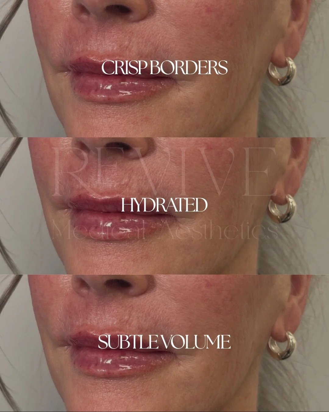Often the issue that I see with new clients isn&rsquo;t how much filler, it&rsquo;s where the filler is sitting and how the lips are actually supporting it.

This client came to me concerned about visible lumps and uneven texture that was creating he