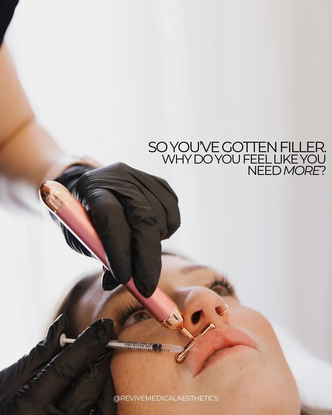One of the hardest parts of this industry is that people are constantly shown overfilled lips and told that&rsquo;s the goal. So when someone still feels unhappy after filler, the assumption becomes:
&ldquo;I probably just need another syringe.&rdquo