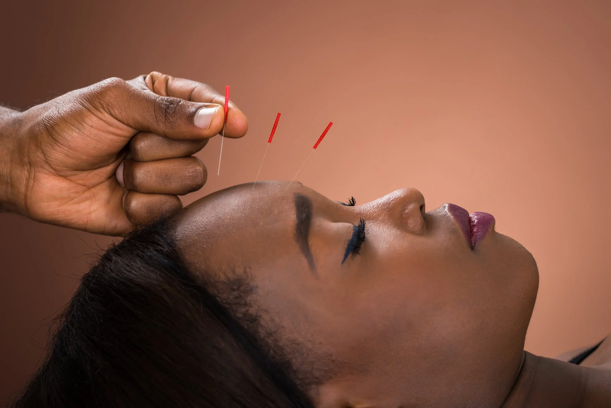 Acupuncture