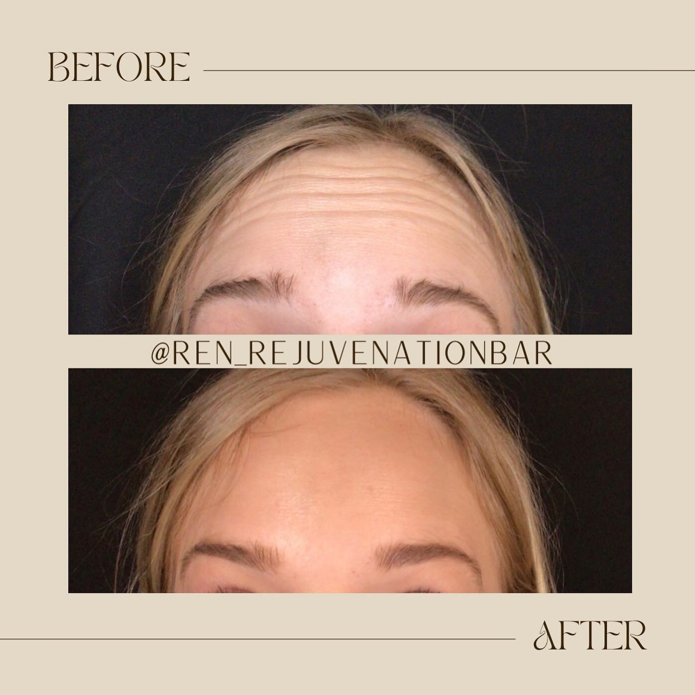 Preventative tox in your 20s helps prevent lines at rest (static lines) from forming. Your future self will thank you 😘

There&rsquo;s no perfect age to start aesthetic treatments&hellip;whether is the prevention, treatment or reversal of the aging 