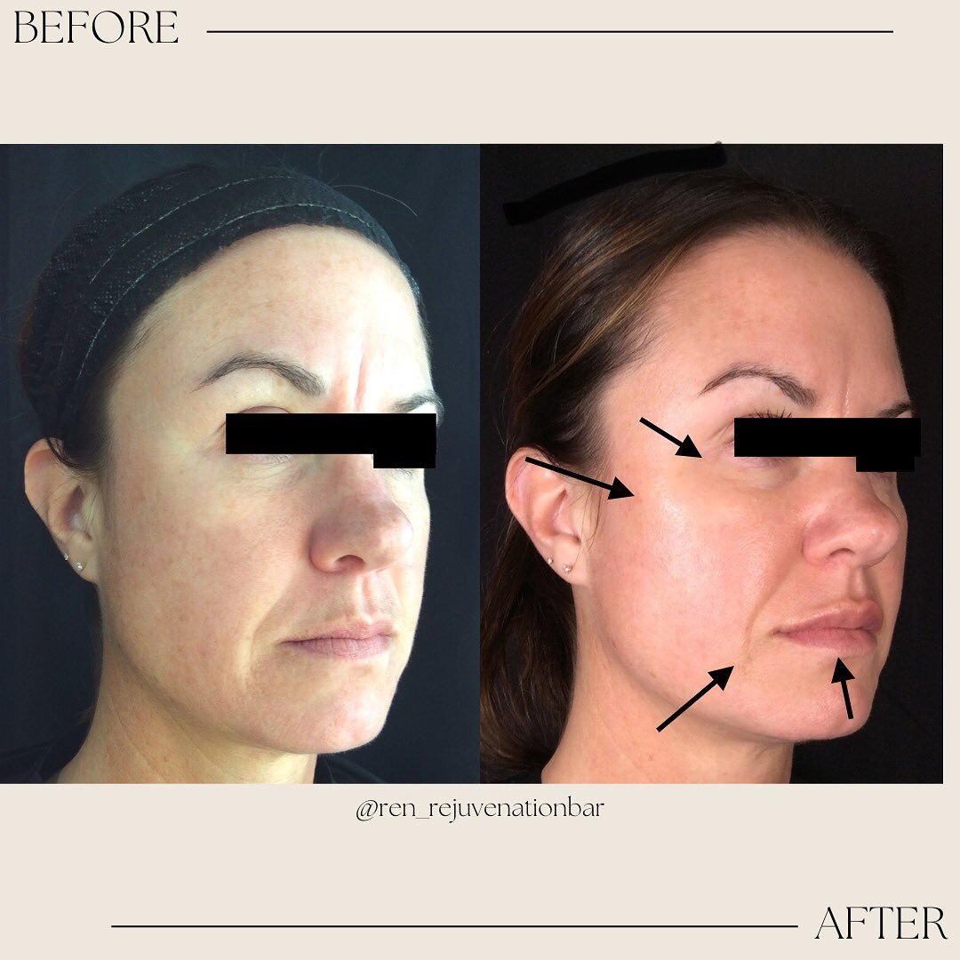 RENlift before + after ✨

This beauty just started her aesthetic journey with us in October!

We started with some RENtox to soften some unwanted lines throughout the forehead, between the brows and the crows feet 
Product: Dysport 
Units: 61 

She t