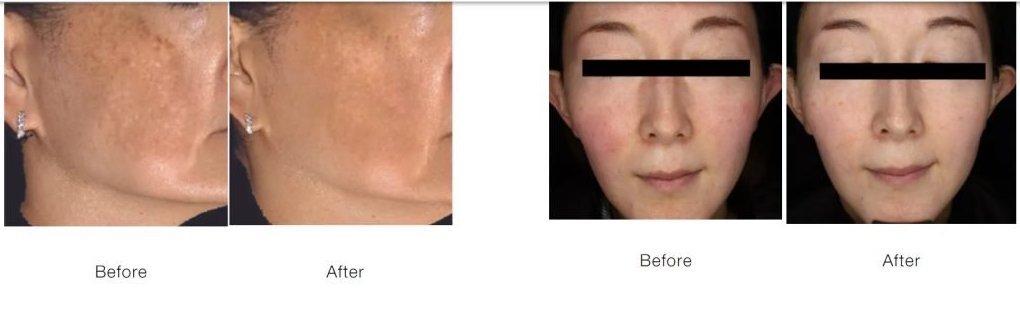SYLFIRM-X-Dual-Wave-RadioFrequency-Microneedling-System-before-after-photos-1024x893.jpeg