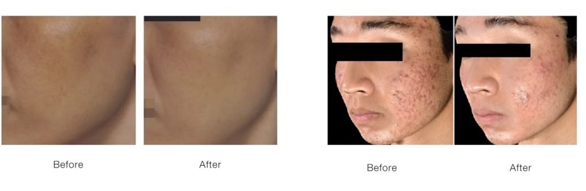 SYLFIRM-X-Dual-Wave-RadioFrequency-Microneedling-System-before-after-photos-1024x893 copy 2.jpg