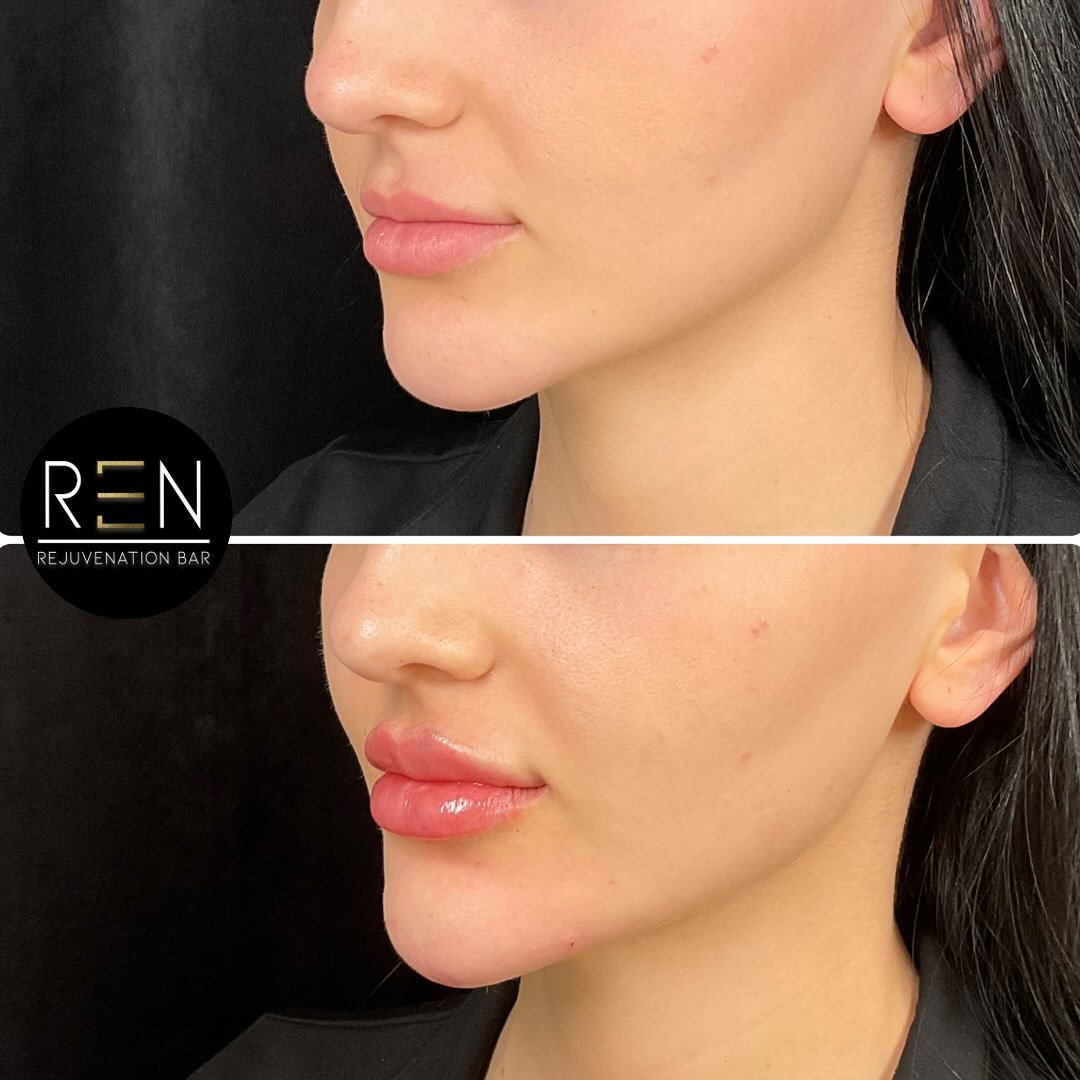 Lips + chin = chef&rsquo;s kiss 

Book your free consultation online at renrejuvenationbar.com

Facial balancing
Lip filler
Chin filler
Lip filler before and after