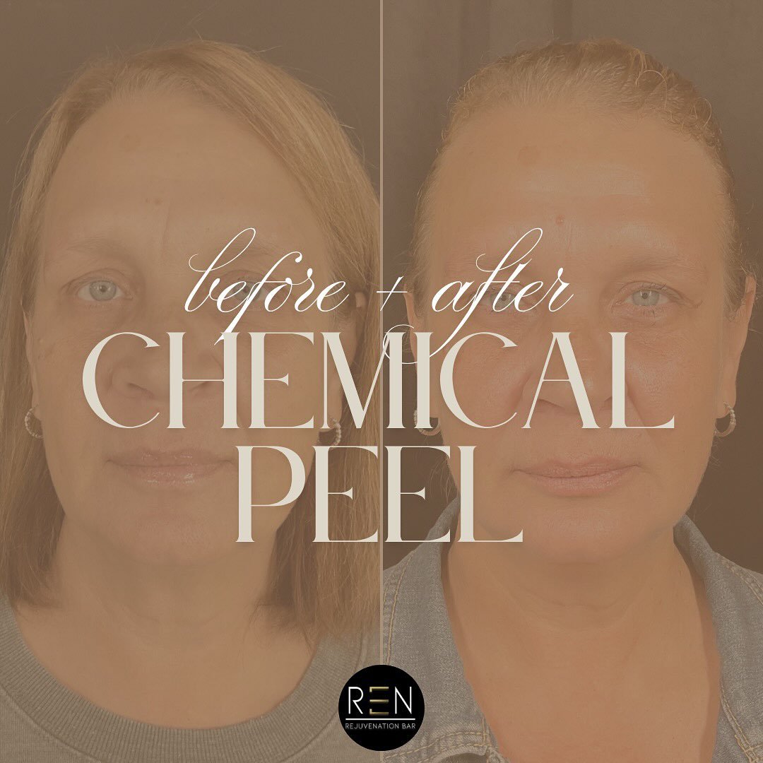 Chemical peels, they&rsquo;re perfect for brightening the skin, encouraging cell turnover, controlling acne, lightening age spots/melasma, and improving the overall tone of the skin!

While summer isn&rsquo;t typically ideal timing for the heavier, d