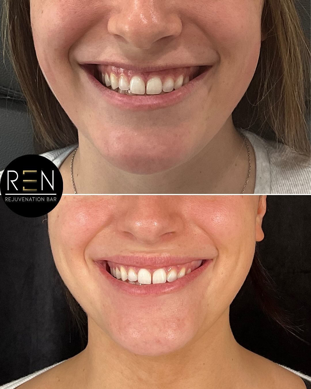 Tox magic 🪄

This gorgeous patient received full face neuromodulator treatment (Botox/Dysport/Letybo) including the following areas:
Lip flip/gummy smile: for less gum show and more lip appearance when animating 
Jelly roll: to reduce bulkiness unde