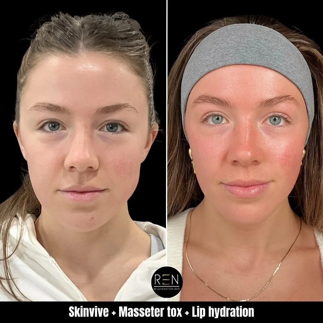 Bridal prep 😍

This beautiful client entrusted us with her bridal prep journey, and her results are absolutely stunning!

Her treatment plan included:
✨ Botox: to her forehead/angry lines to give her upper face a wrinkle free glow. Also to her masse