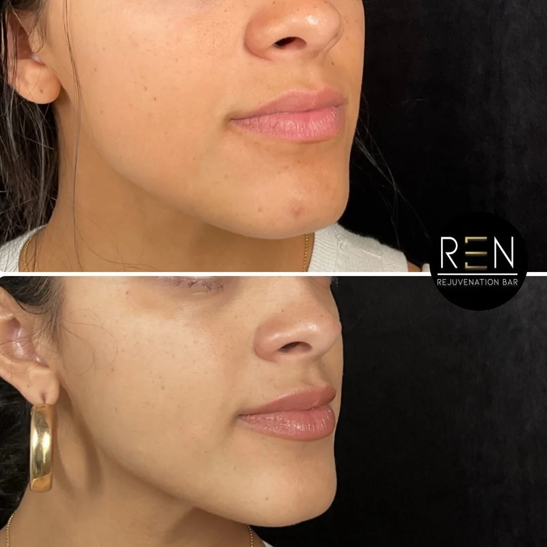 Hydrated, natural lip transformation ✨

This beautiful client wanted a subtle change to her already gorgeous natural lips, so we opted for 1/2 syringe to focus on hydration + texture.

This typically lasts 6-18 months, depending on type of product an