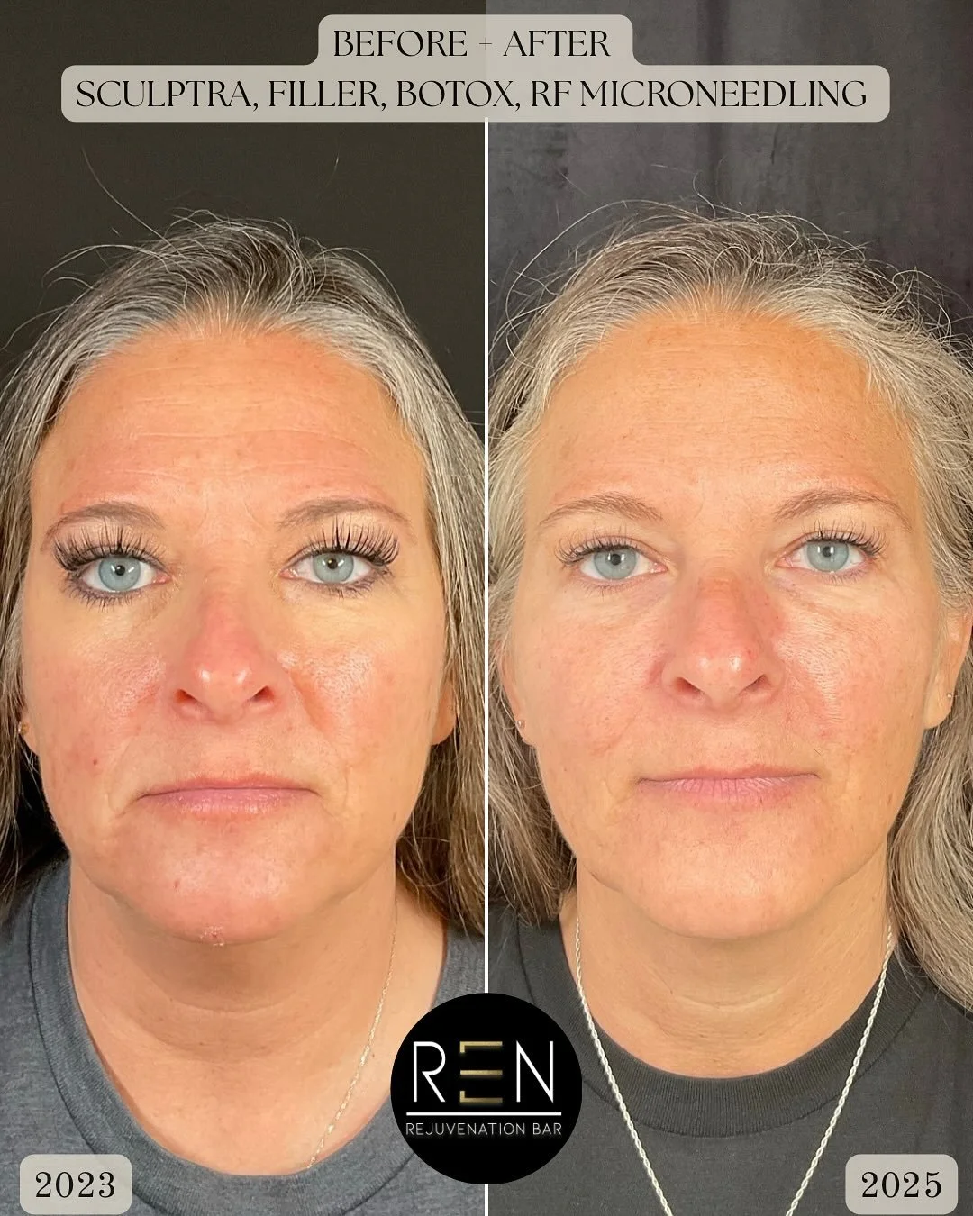 A transformation, two years in the making!

This beautiful patient began her aesthetic journey with us two years ago, starting with Botox to address fine lines + wrinkles in her forehead. Over the past two years, we&rsquo;ve slowly and intentionally 