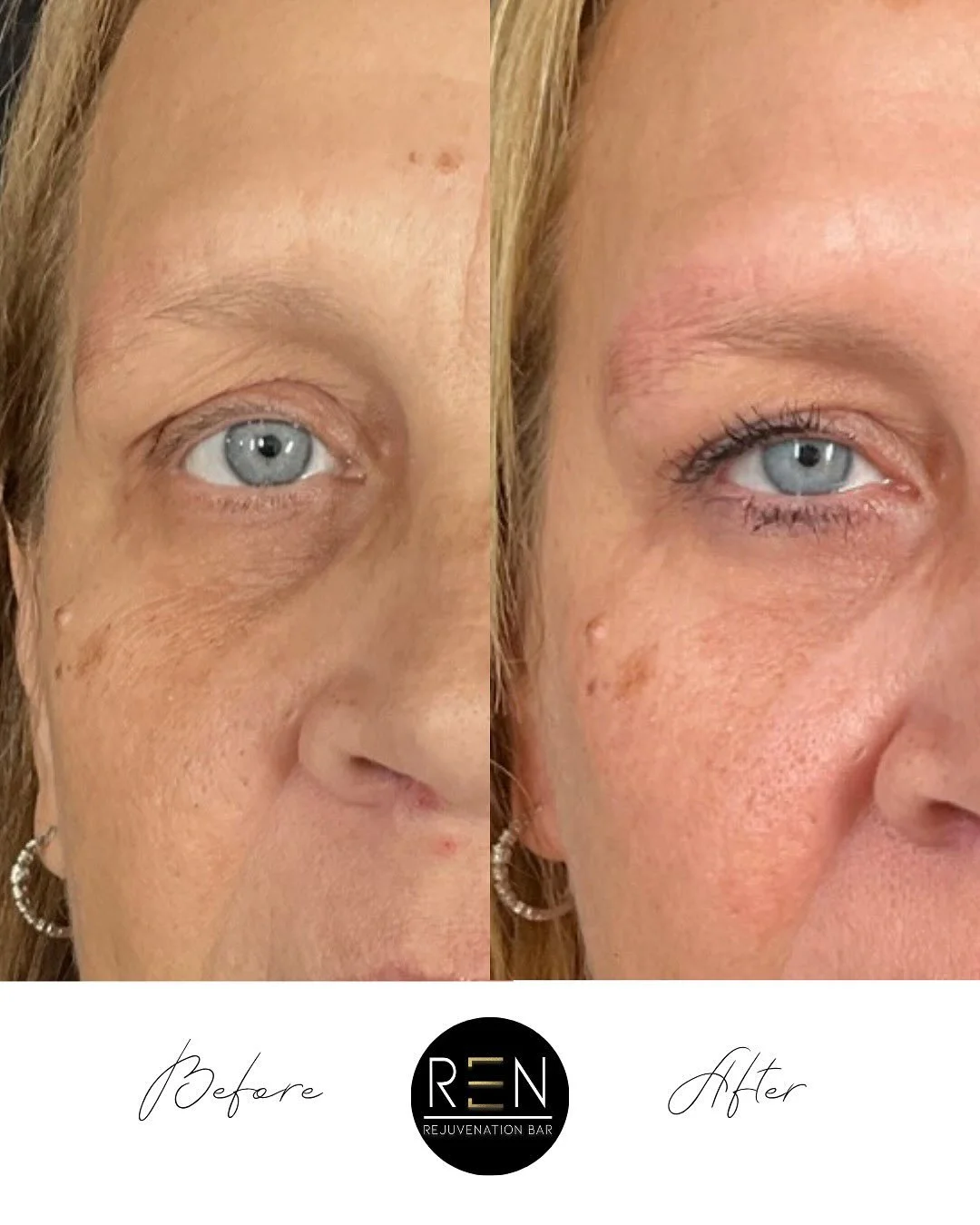 Undereye Rejuvenation with our signature BioBright Eye treatment ✨

This treatment uses advanced biologic technology to simulate collagen production and healing, targeting common undereye issues such as 
✨ Thin, crepey skin
✨ Dark pigmentation
✨ Holl