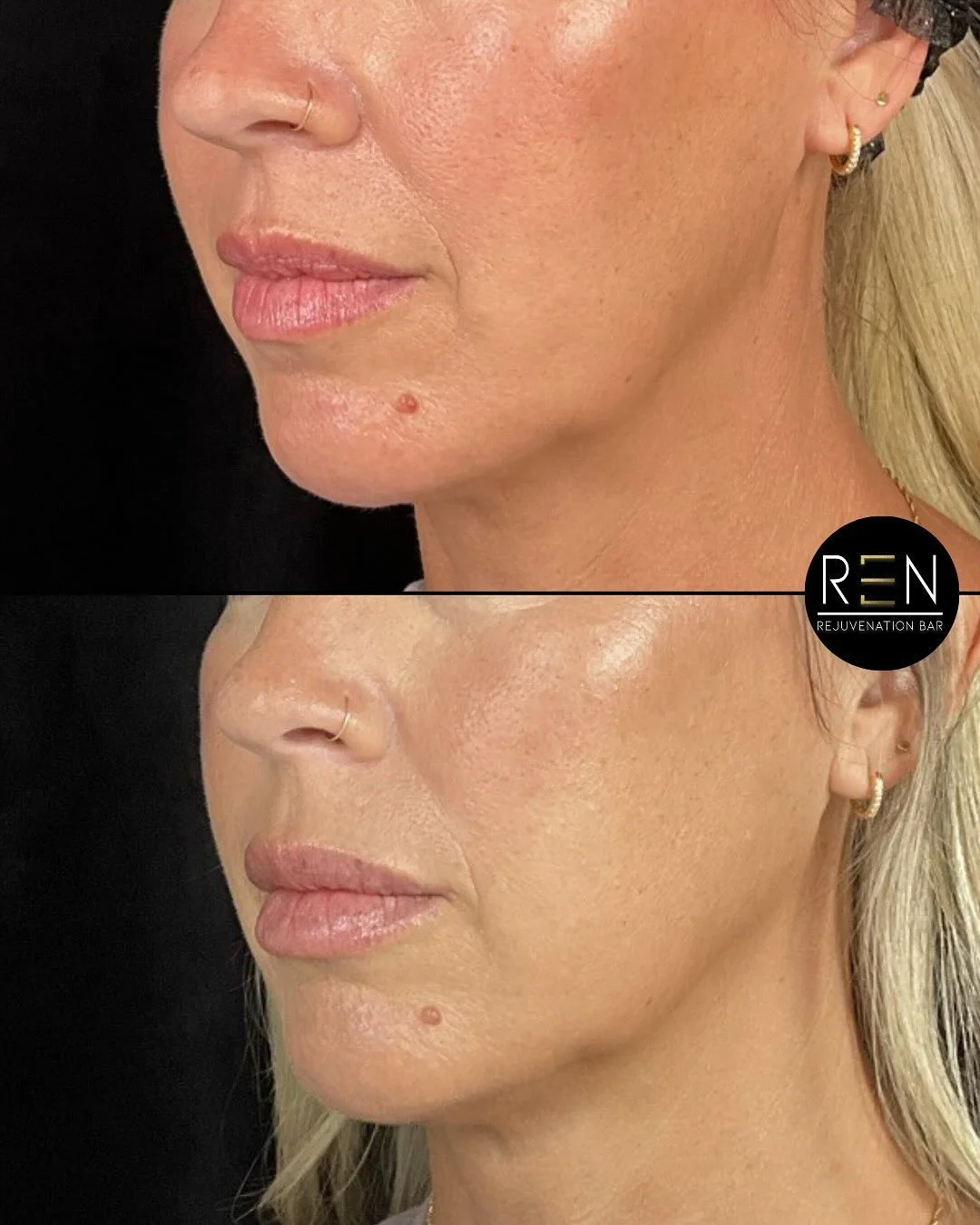 Lip hydration 💧

This beautiful client recieved 1 syringe of our new favorite product, Evolysse Smooth, for a hydrated pout! This product feels and looks super natural once settled, enhancing her already beautiful, full lippies!

Treatment: Lip Fill
