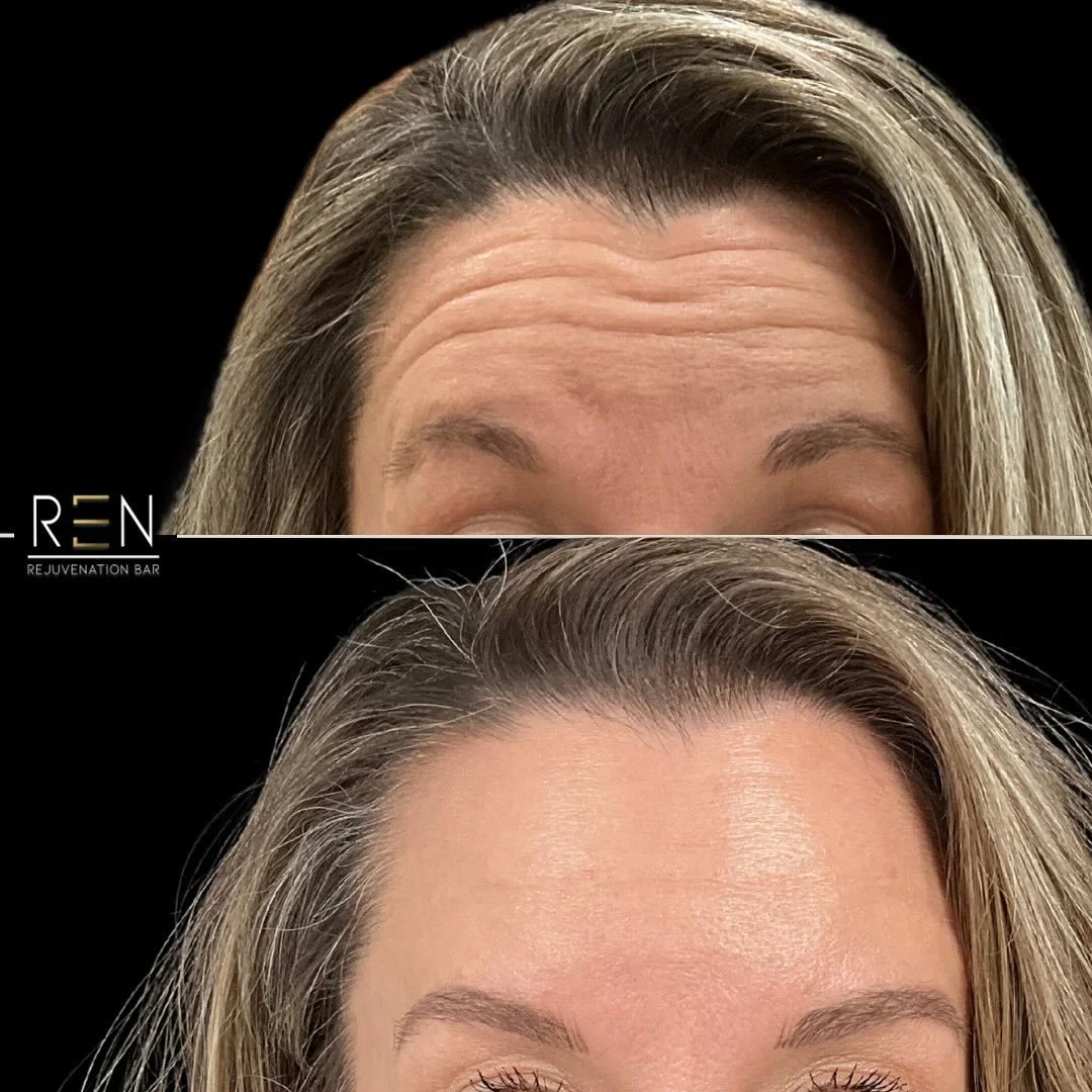 Wrinkles, softened ✅

Book a free consultation online at renrejuvenationbar.com

#botoxbeforeandafter #wrinklerelaxer