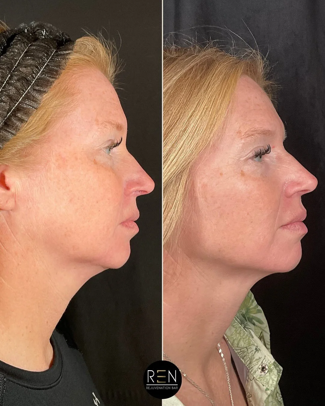 Sculptra = Magic 👀

This client received her booster vial of sculptra continue the fight against the aging process, focusing on giving her support to her cheeks + jawline. We can visually see the improvement in her nasolabial fold, smile lines and u