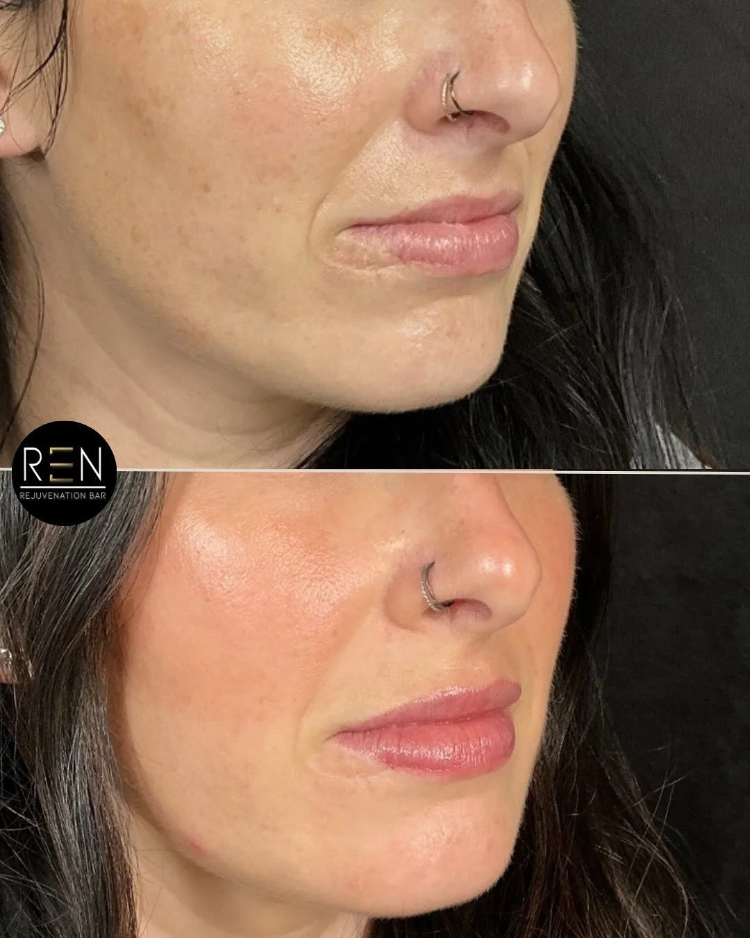 Happy Monday ✨

We love this lip transformation, a subtle can be so impactful! We focused on hydration and scar revision, leaving her with a soft, natural result!

Treatment: lip filler
Product: 1/2 syringe of Restylane Kysse + Refyne
Duration: 6-18 