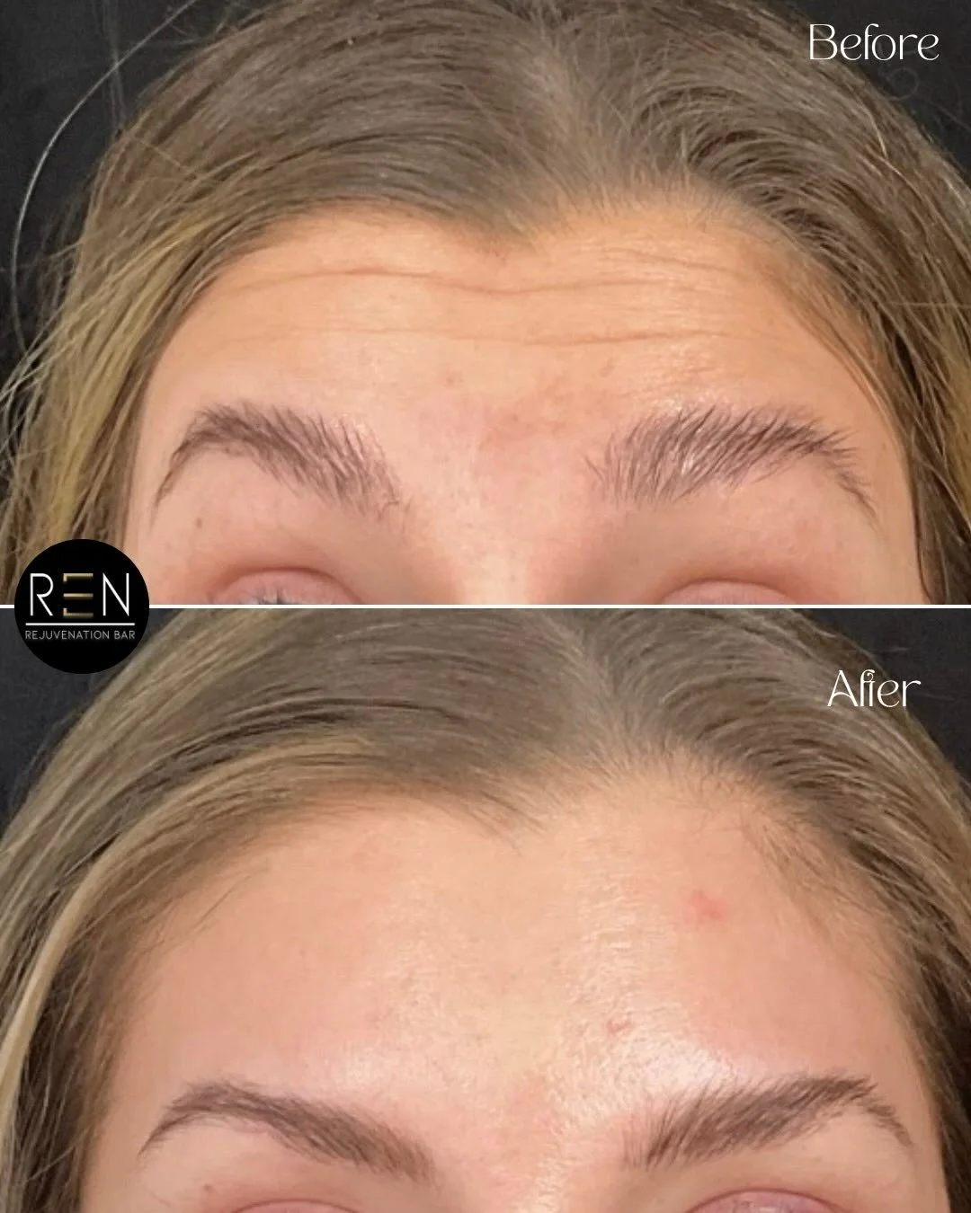 We hope your Monday is as smooth as her forehead 🙌🏼

Treatment: Botox/Dysport/Letybo
Onset: 2 weeks for full results 
Effect: 3-4 months of wrinkle relaxation 
Cost: $12/unit (units vary depending on area of treatment/anatomy)

Book a free consulta