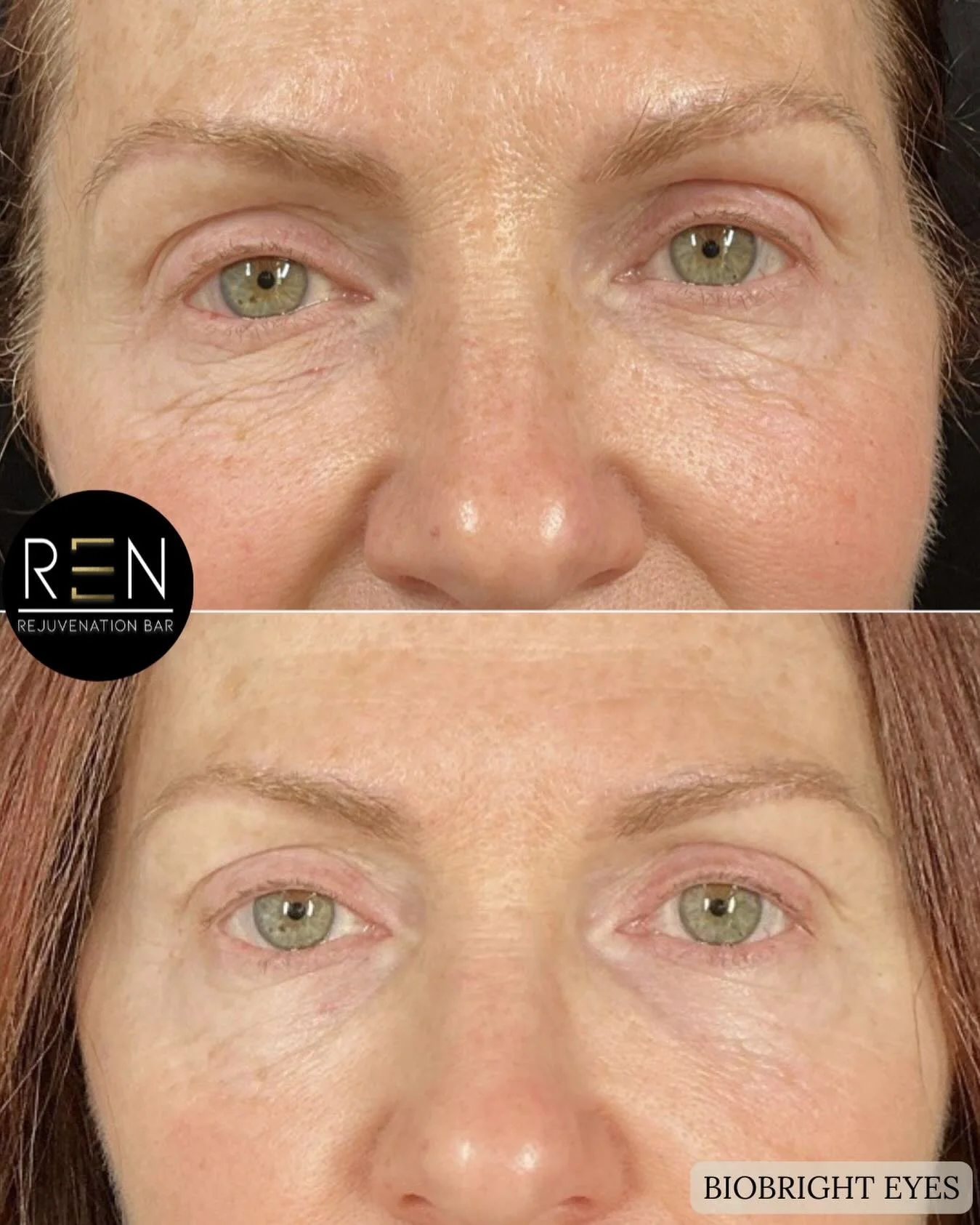 Undereye treatments, reimagined ✨

By harnessing the power of advanced growth factors, we are able to target the very delicate undereye area for problems such as:
✨ Thin, crepey skin 
✨ Dark pigmentation 
✨ Hollowing
✨ Fine lines + wrinkles

Treatmen