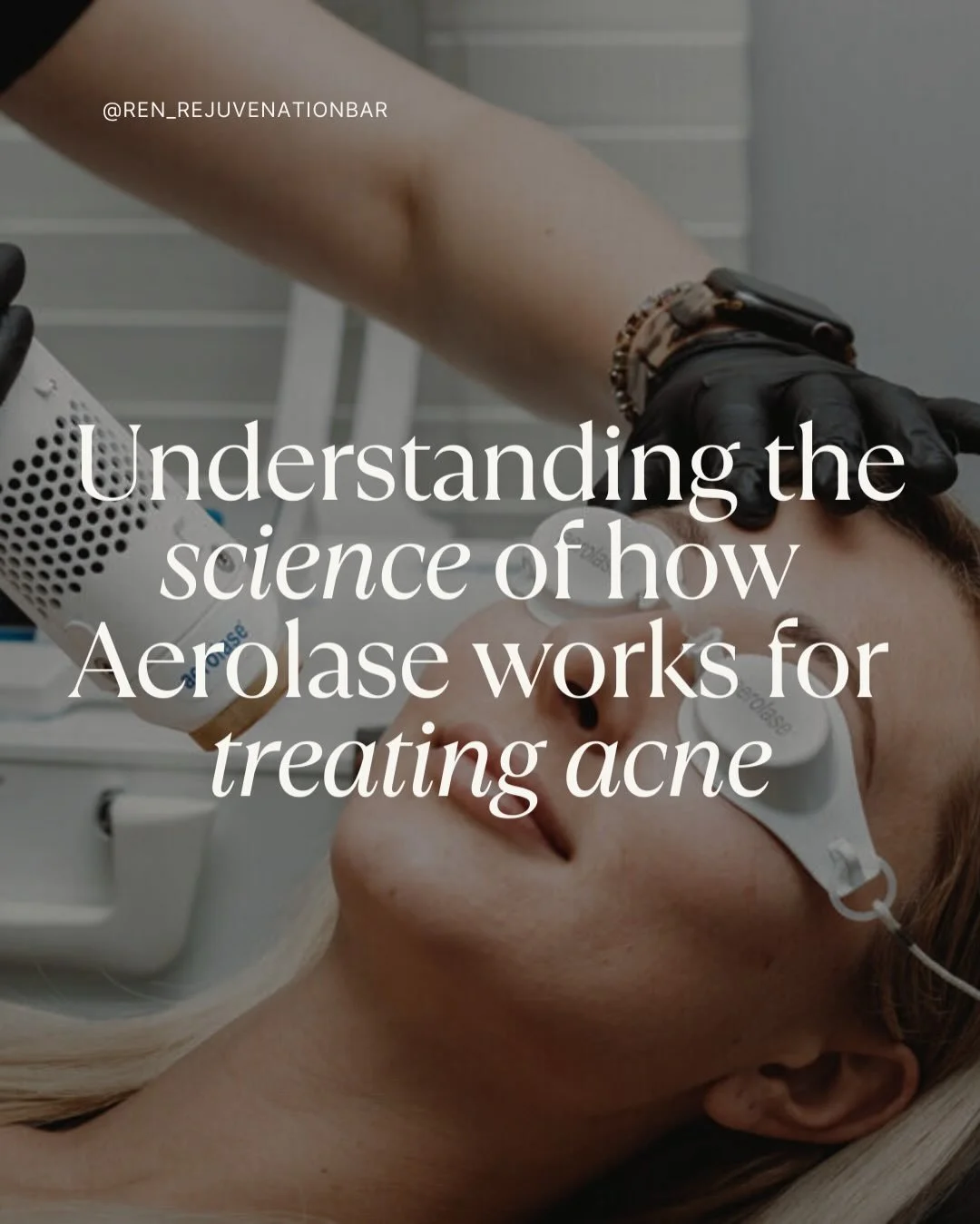 Aerolase Laser for Acne 👏🏼

The Aerolase Neo Elite is one of our favorite tools for treating active acne because it targets the root causes without irritating the skin. Using a gentle 650-microsecond laser, it reduces inflammation, kills acne-causi